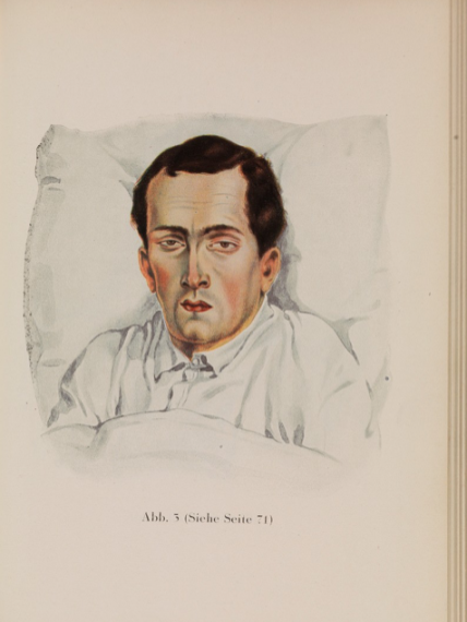 Man with Typhoid Wellcome